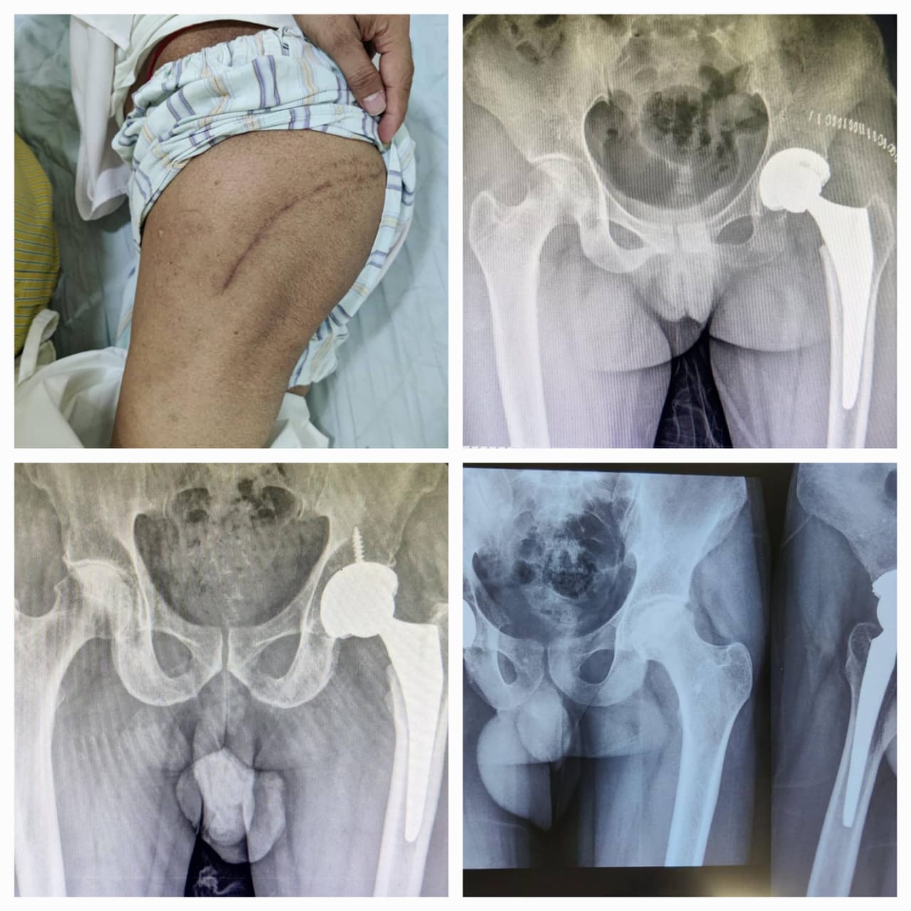 TOTAL HIP REPLACEMENT : HIP ARTHROPLASTY